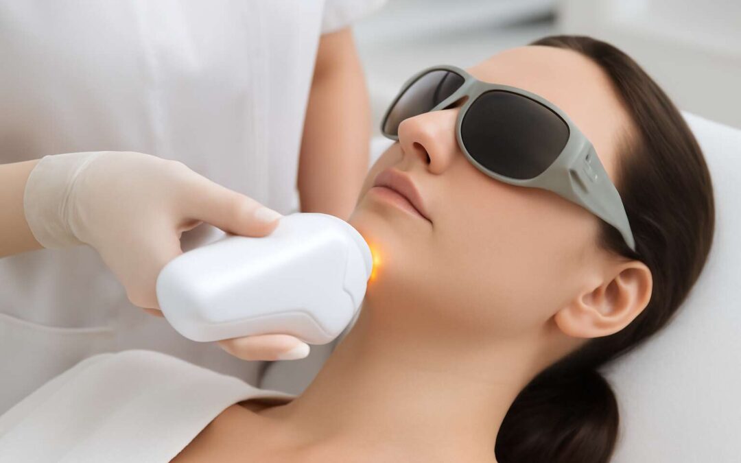 can you do laser hair removal on chin