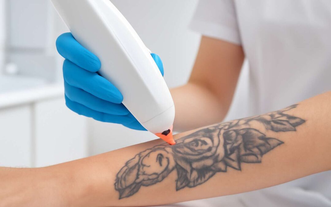 Effortless glow: laser hair removal with tattoos for smooth, ink-safe skin.