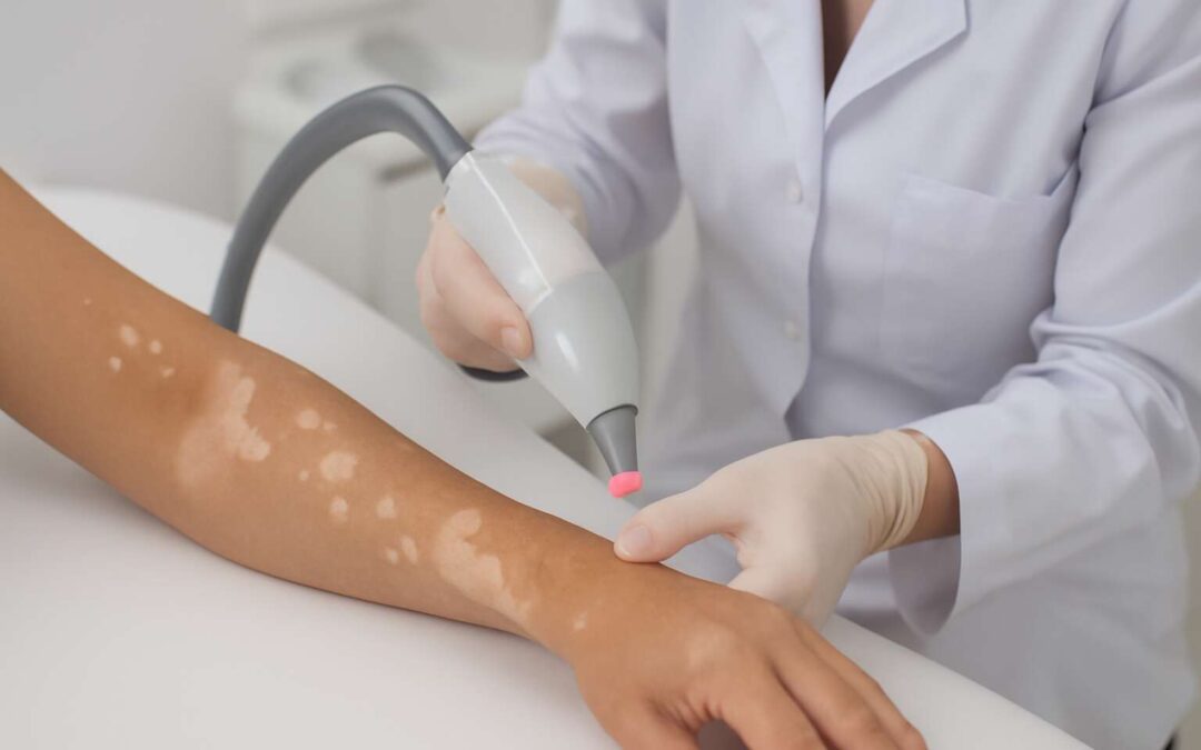 Discover laser hair removal vitiligo: practical safety tips and what to expect.