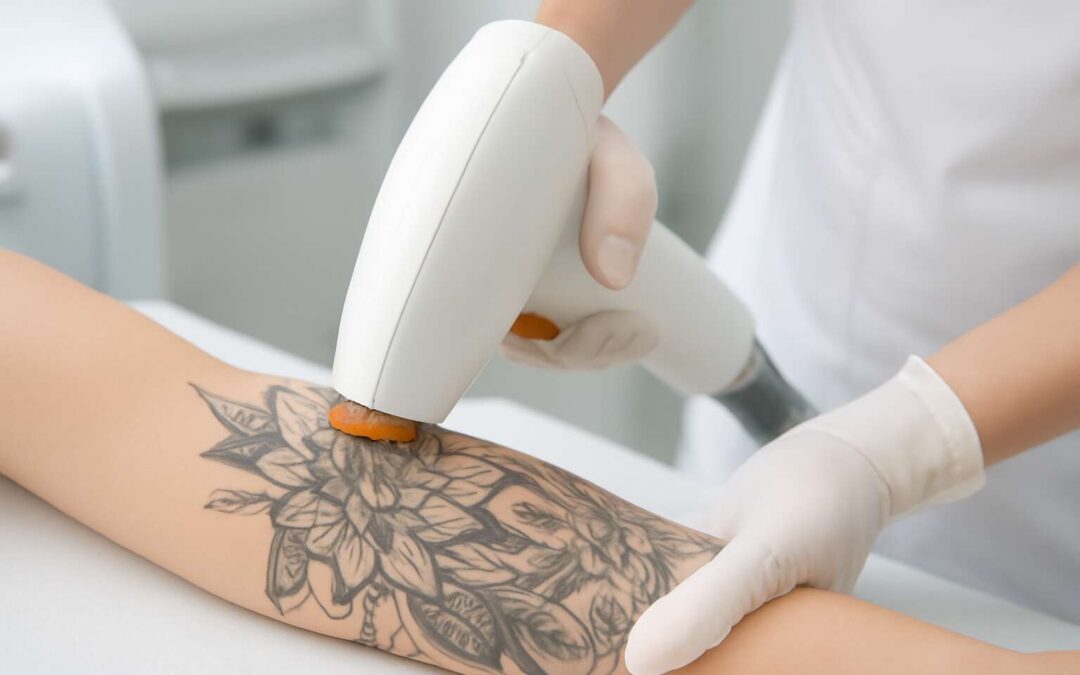 laser hair removal over tattoo: A practical guide to treatment and care.