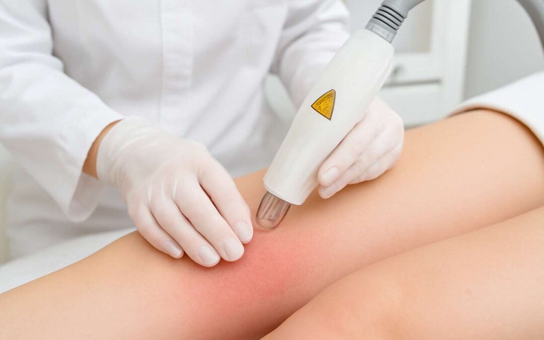 Navigating laser hair removal side effect: tips for safer results